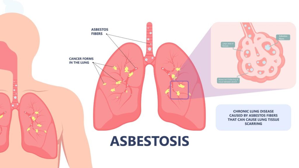 symptomen asbestose 